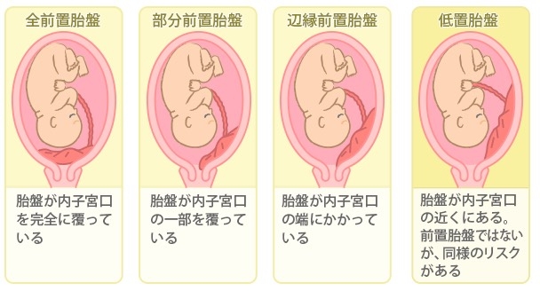 妊娠中の異常 前置胎盤 医療法人玲聖会